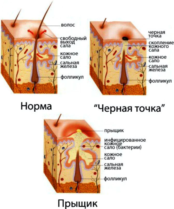 Прыщи у взрослых — причины, лечение и уход за кожей