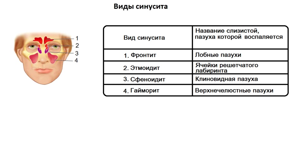 Синусит и гайморит - в чем разница и сходства, чем отличаются друг от друга