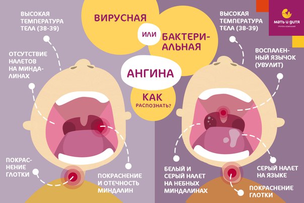 Какие бывают заболевания горла и в чем их отличия?