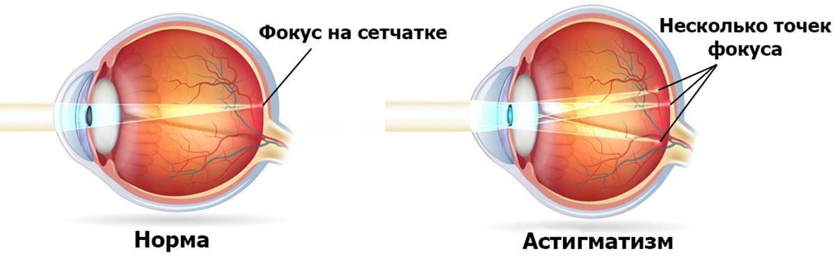 Дальнозоркость и близорукость отличие одного от другого, что лучше или хуже, чем отличается лечение