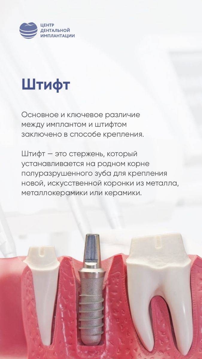 Штифт или имплант: как выбрать лучший метод восстановления зубов | медицинская энциклопедия