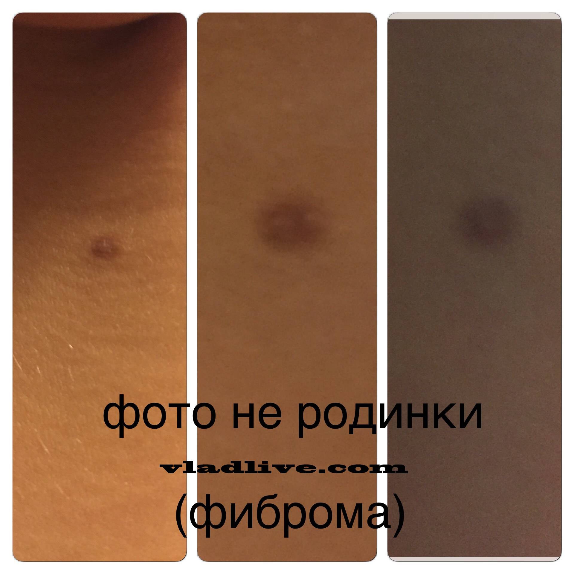 Родинка или папиллома: как правильно распознать