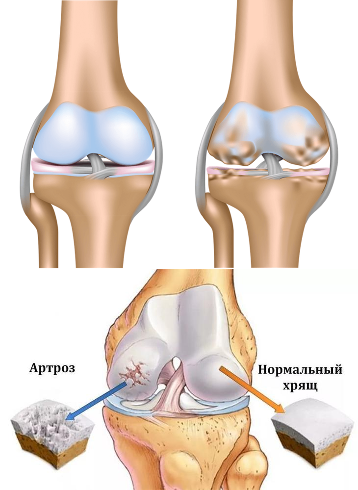 Артрит и артроз: в чем различие?