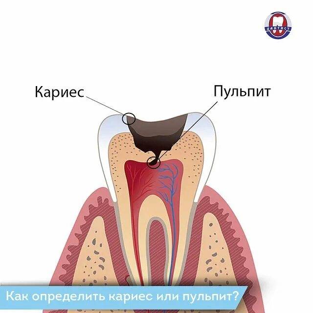 Чем отличается кариес от пульпита: как распознать заболевания | za-rozhdenie.ru