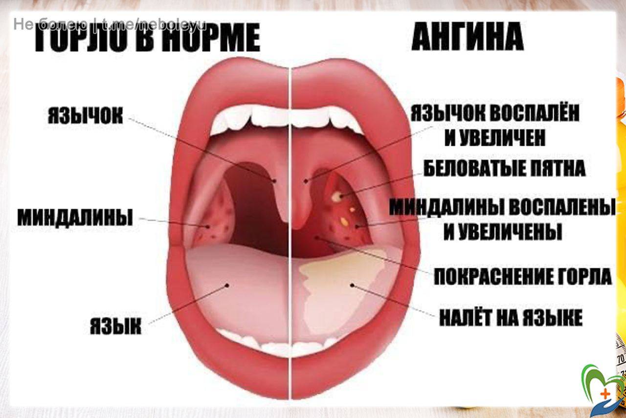 Как выглядит больное горло?