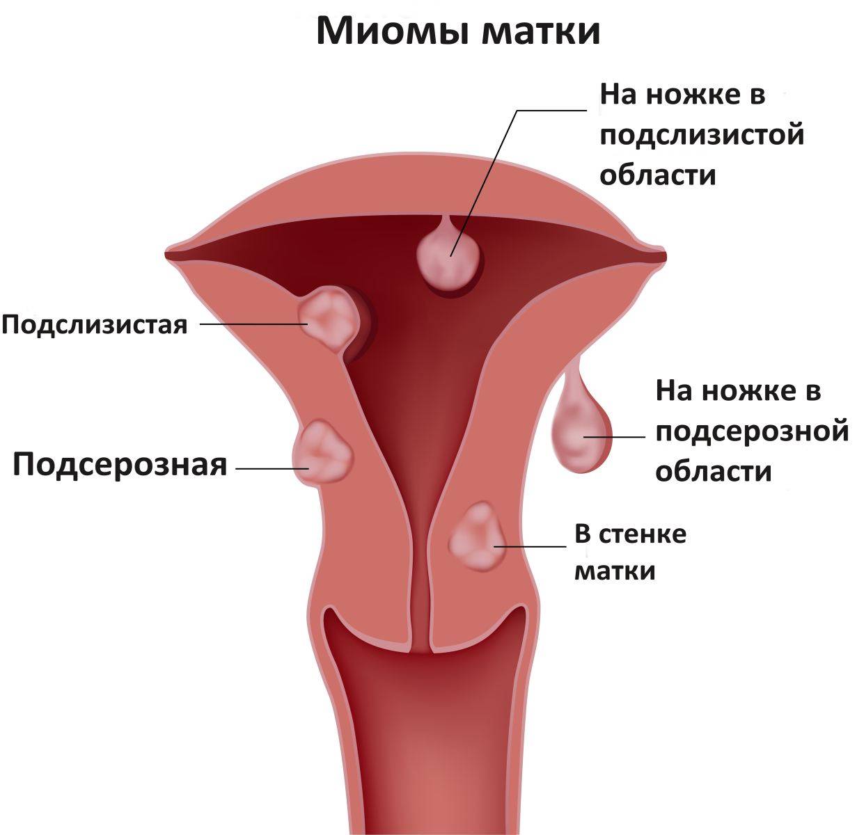 Фибромиома матки: что это такое, симптомы, причины и лечение у врача акушера-гинеколога в мкц «проксима» (г. сочи)