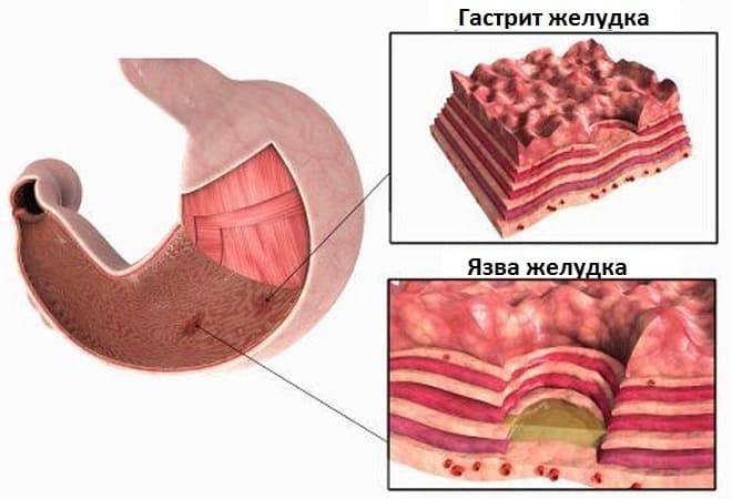 Язвенная болезнь желудка и 12-перстной кишки: причины, анализы, консультация гастроэнтеролога, диагностика, профилактика, методика лечения | услуги клиники «проксима» (г. сочи)
