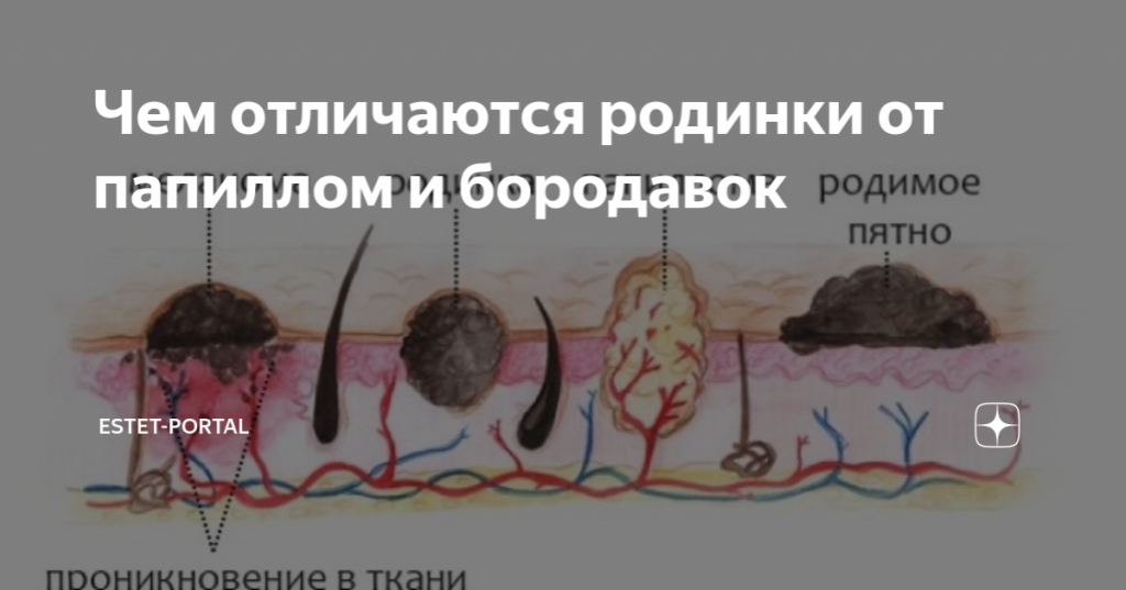 Что, как и когда появляется на коже — что с этим делать? — контагиозные моллюски, папилломы, кондиломы
