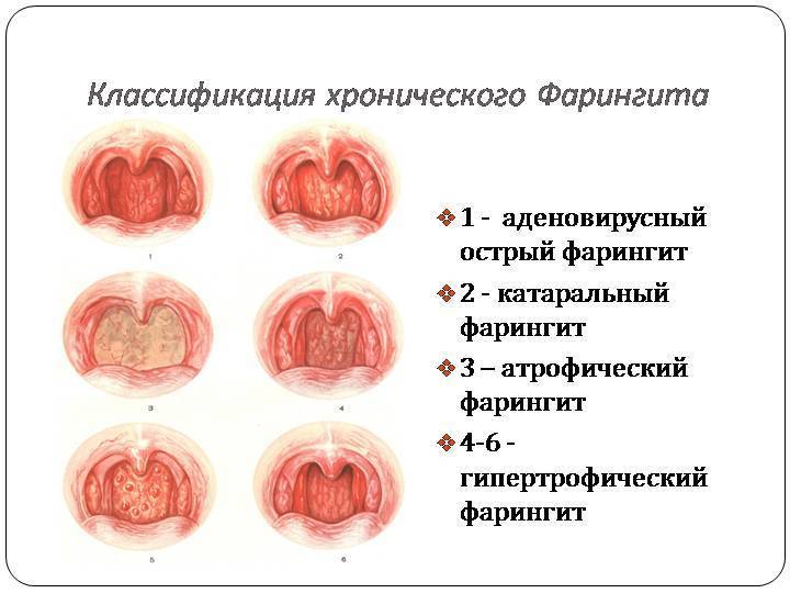 Острый тонзиллит или ангина