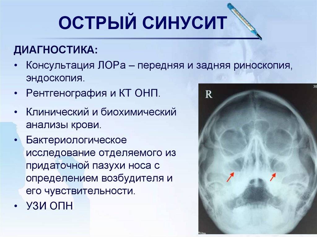 Симптомы, лечение и профилактика хронического синусита
