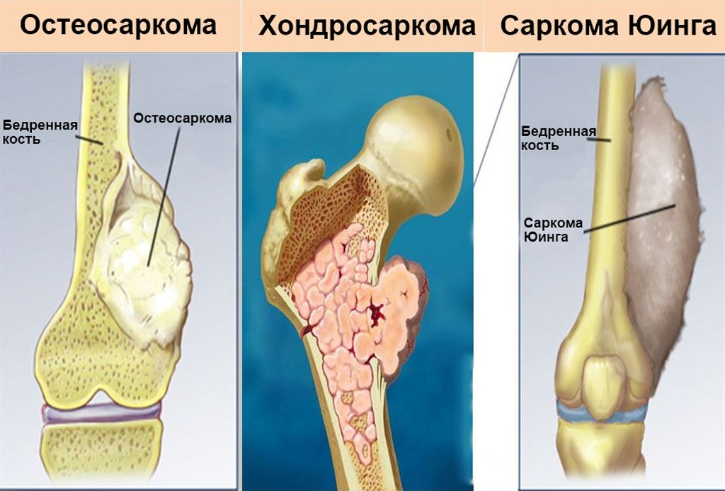 Чем рак отличается от саркомы?
