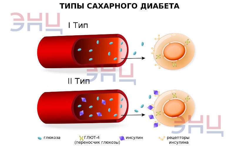 Виды сахарного диабета