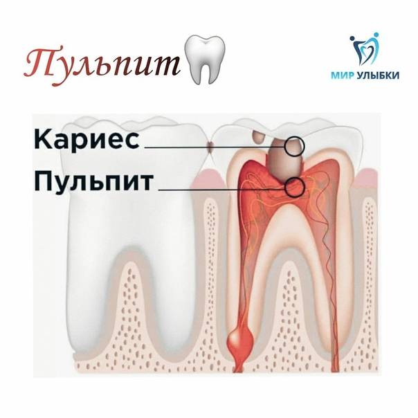Основные отличия кариеса от пульпита