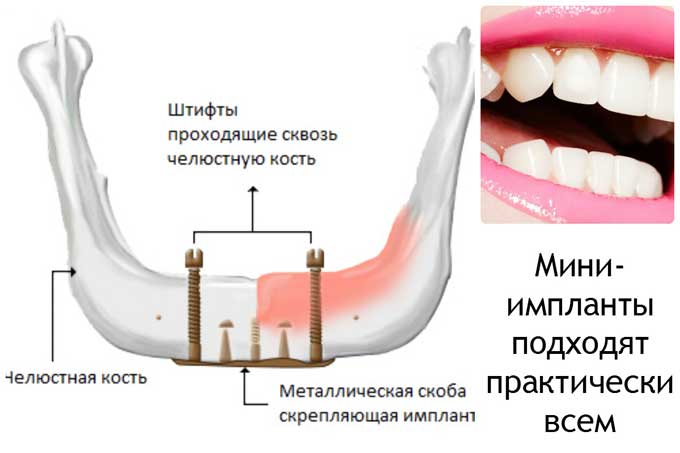 Дентальная имплантация зубов - что это, сколько стоит и как выполняется