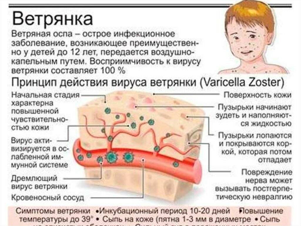 Ветрянка (ветряная оспа): симптомы и лечение – напоправку – напоправку
