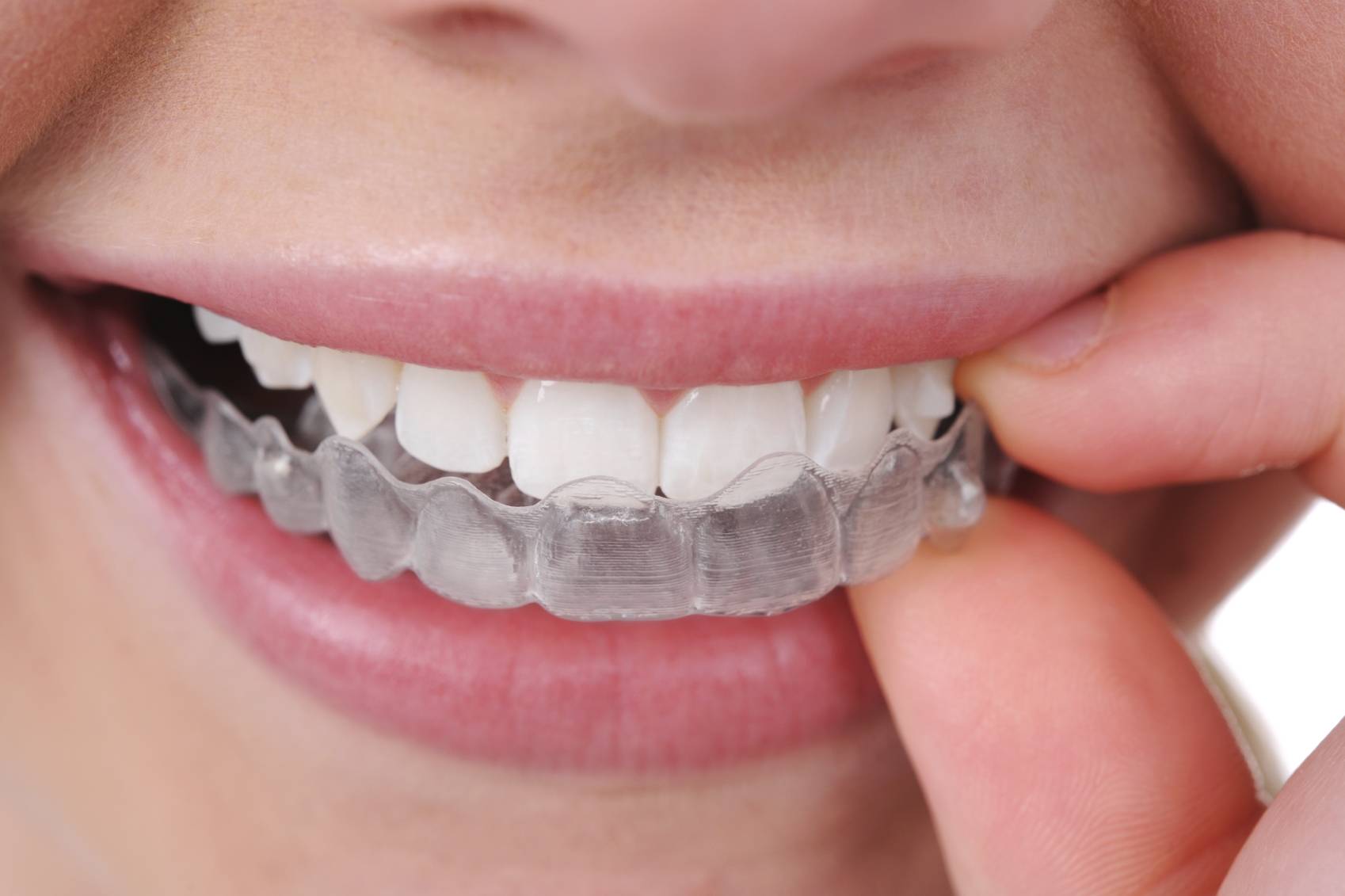 Исправление прикуса без брекетов с помощью капп invisalign