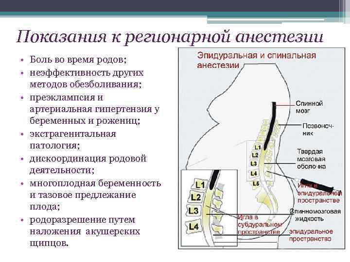 Эпидуральная анестезия при родах — что это, как делают и опасно ли это?