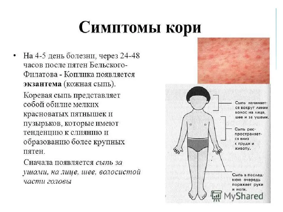 Корь: кто ею болеет и почему вспышки кори регистрируются все чаще? как защитить от кори себя и своих детей?
