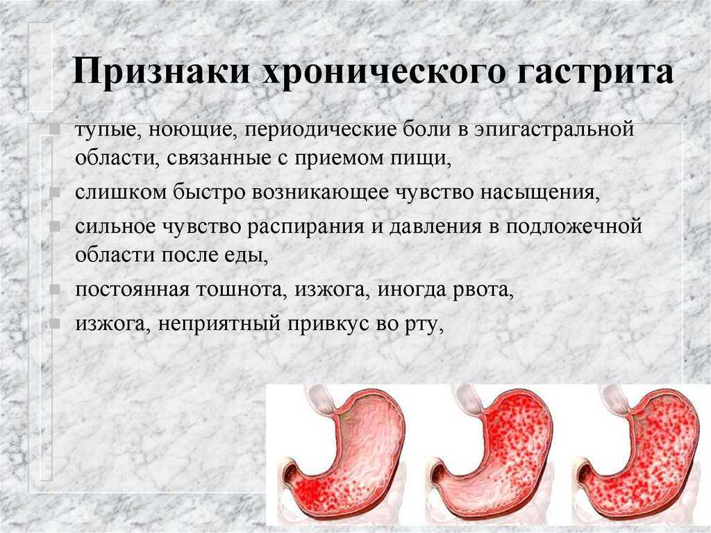 Язвенная болезнь  желудка и двенадцатиперстной кишки