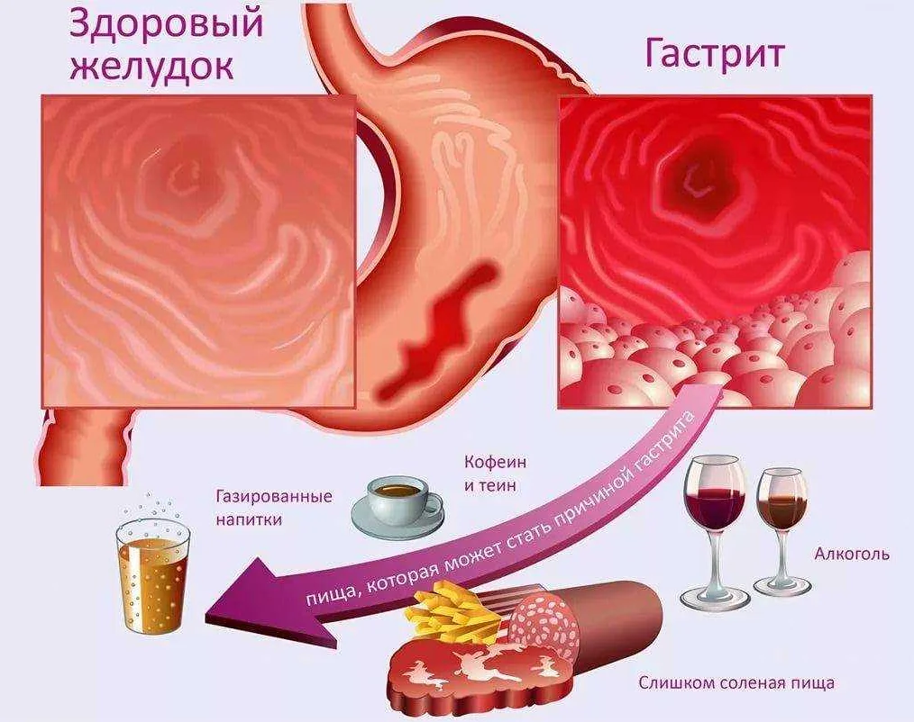 В чем разница между гастродуоденитом и гастритом
