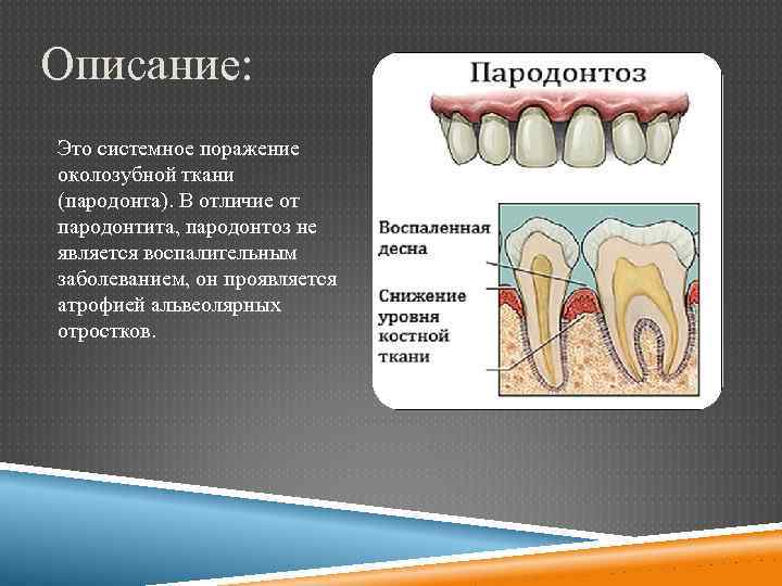Чем отличается пародонтоз от пародонтита. подробности в нашей статье