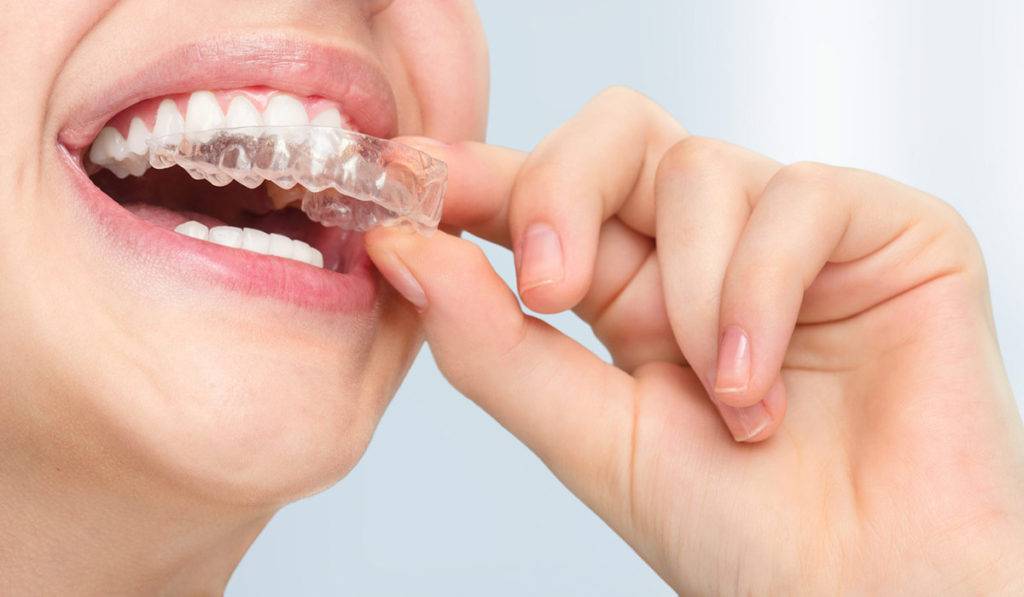 Каппы invisalign — лучшая альтернатива традиционным методам коррекции прикуса