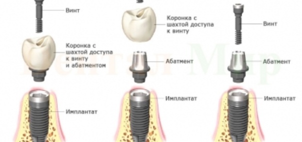 Что лучше поставить: мост, коронку или имплант