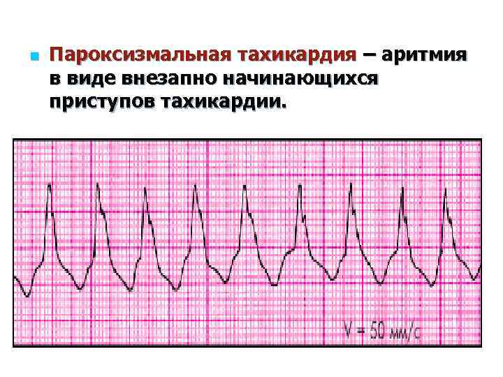 Тахикардия: причины, симптомы, классификация, лечение, чем опасна, профилактика