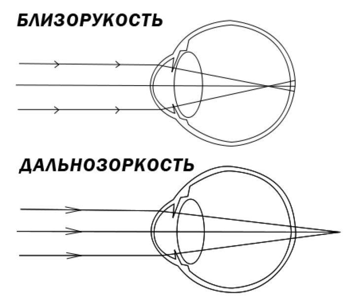 Что такое близорукость и дальнозоркость