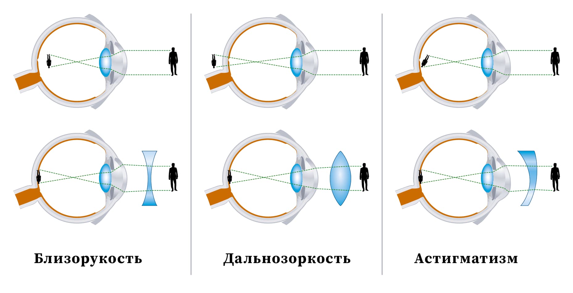 Как определить близорукость или дальнозоркость: основные различия