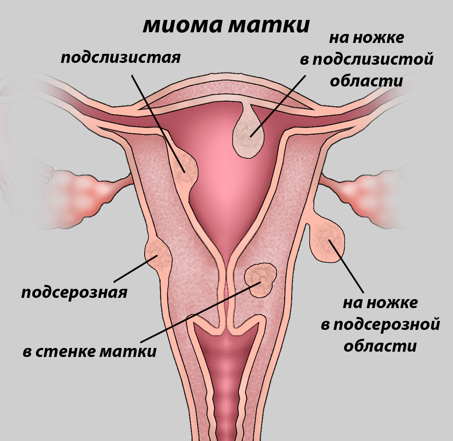 Фибромиома и миома в чем разница
