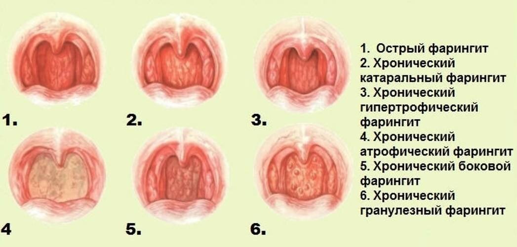 Чем отличается фарингит от ларингита: симптомы болезней горла и голосовых связок, терапия, осложнения