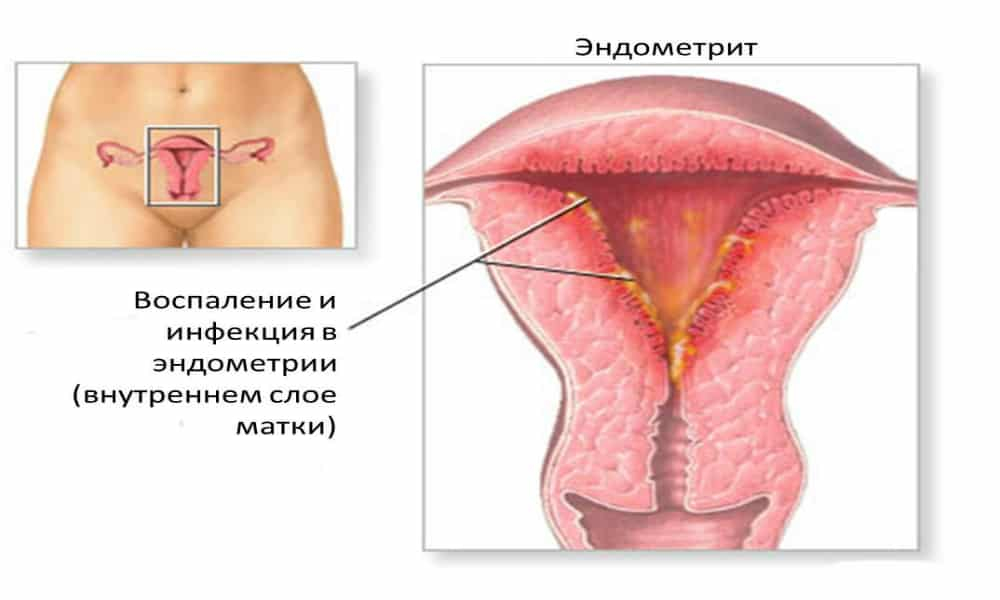 Эндометриоз матки – симптомы, лечение, диагностика