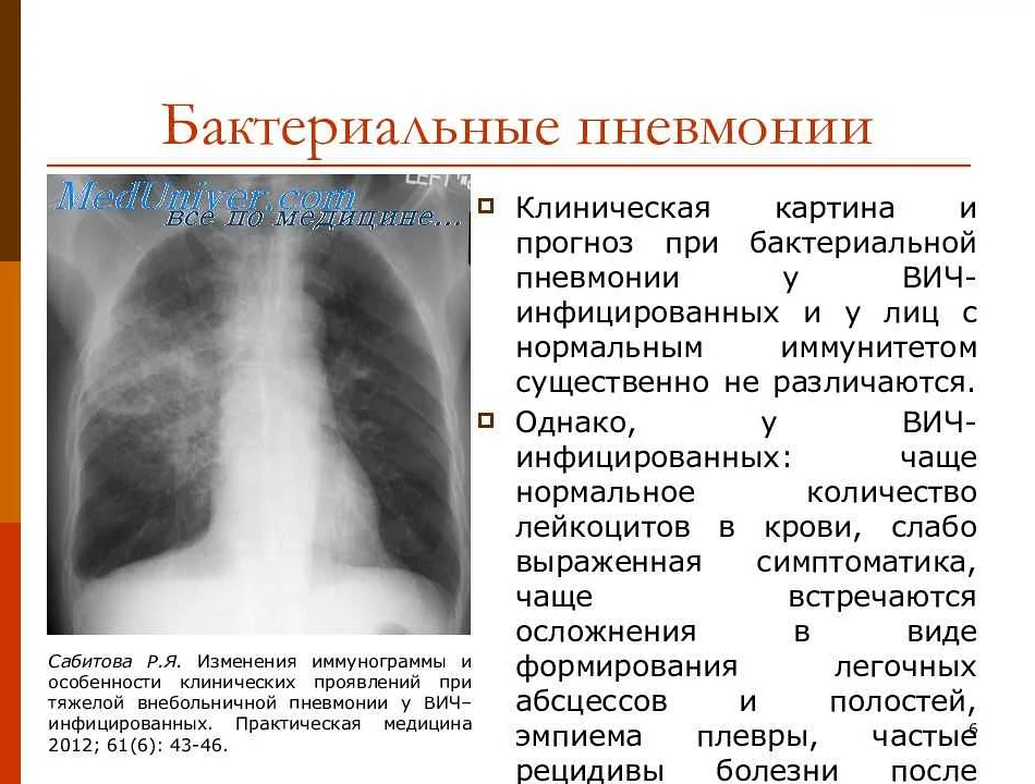 Пневмония (воспаление легких) – причины, виды и формы (вирусная, бактериальная, грибковая, острая, двусторонняя, атипичная), признаки и симптомы, методы диагностики заболевания