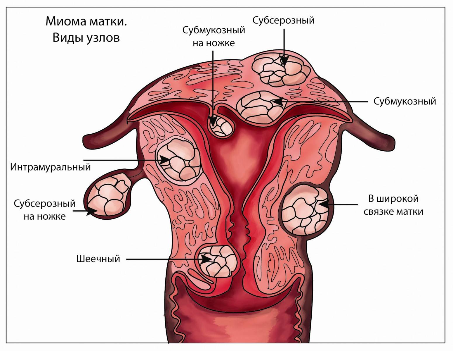 Чем отличается миома от фибромы - разница, отличия