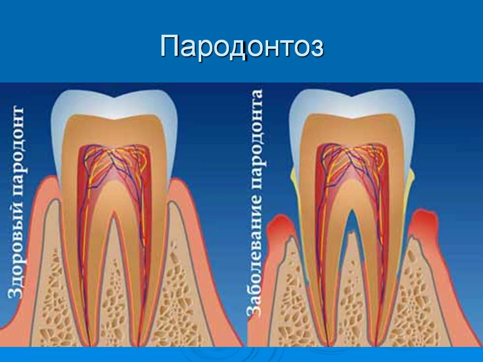Заболевания десен: гингивит, пародонтит, пародонтоз | metrogyl-denta