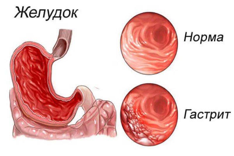 Гастрит
