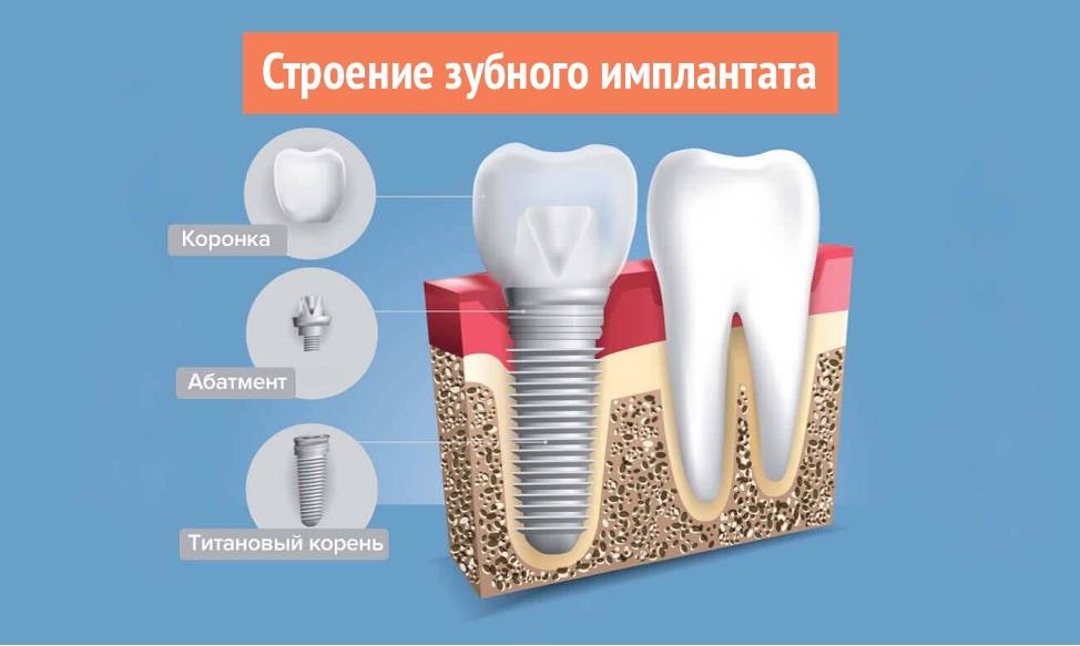 Коронка или имплант: что лучше выбрать