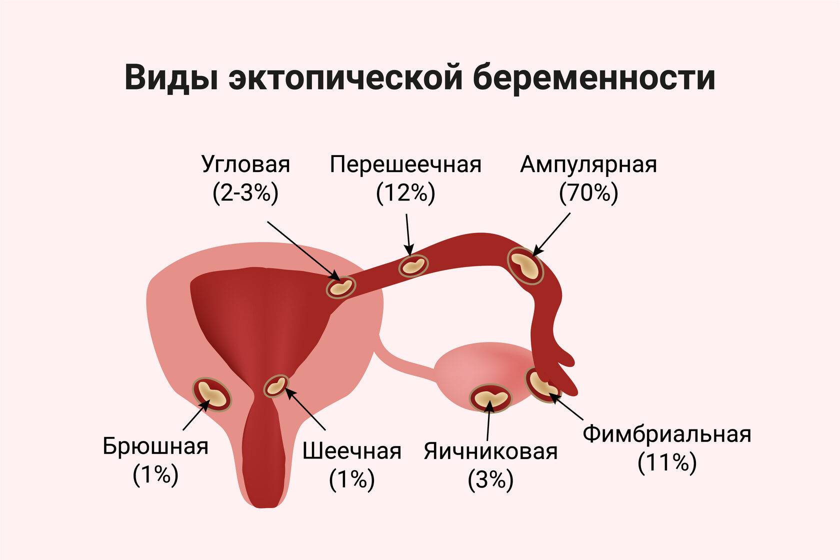 Внематочная беременность