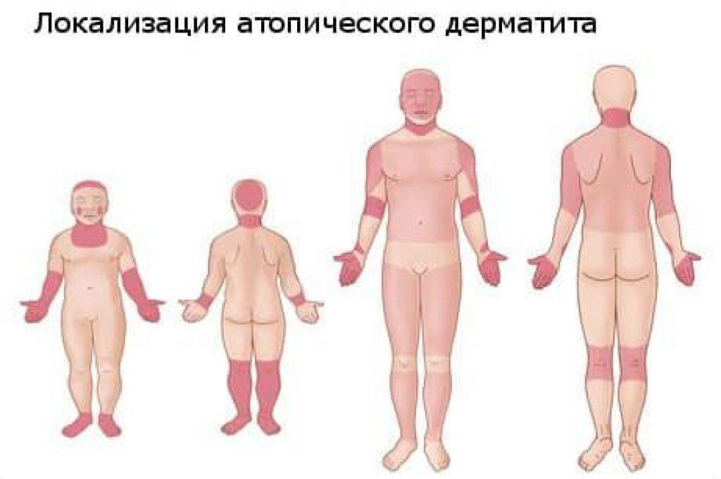 Дерматит - что это такое и от чего бывает: причины, симптомы и лечение хронического кожного заболевания у взрослых - классификация признаков и профилактика болезни кожи