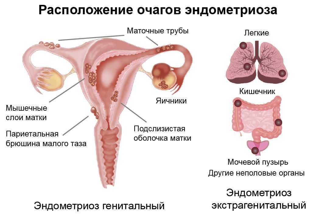 Эндометрит и эндометриоз - в чем разница?