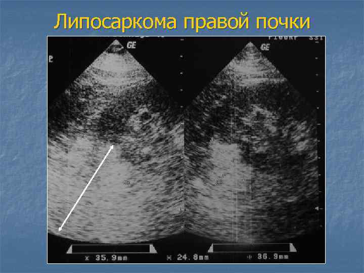 Что такое липосаркома и как ее лечить? | познание мира