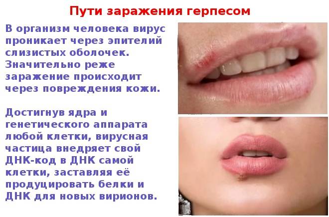 Как отличить герпес, симптомы и ощущения при герпесе