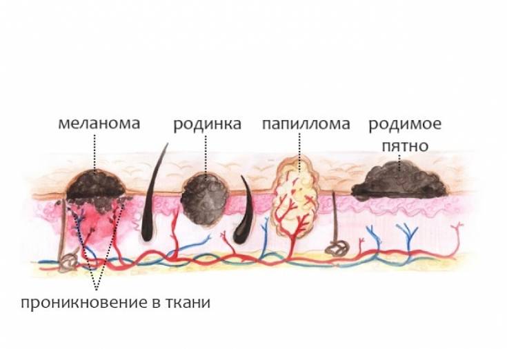 Разница между бородавкой и папилломой