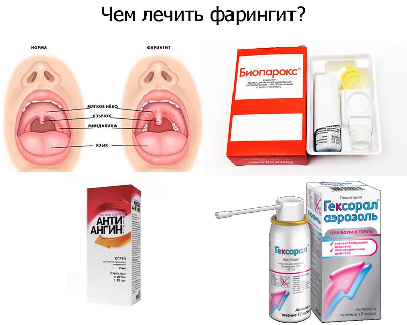 Фарингит, ларингит или ангина?