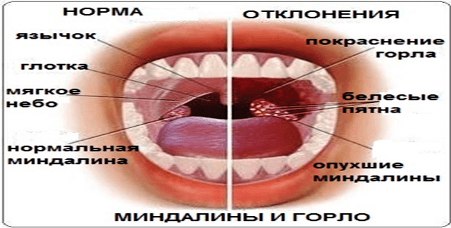 Гланды и миндалины, аденоиды — в чем различия?