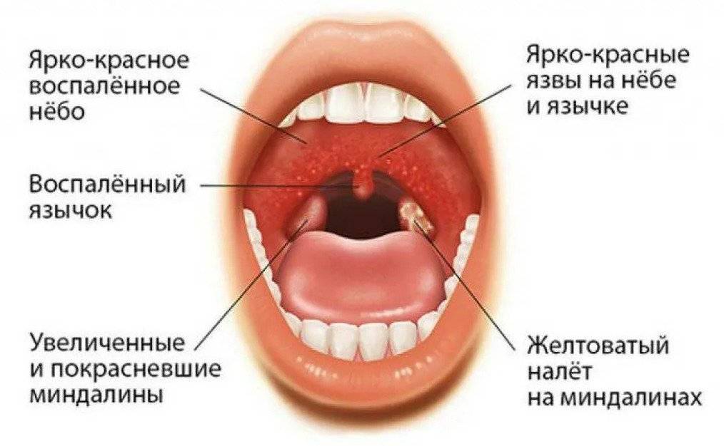 Симптомы ангины и отличие от орви | есть ли кашель при ангине