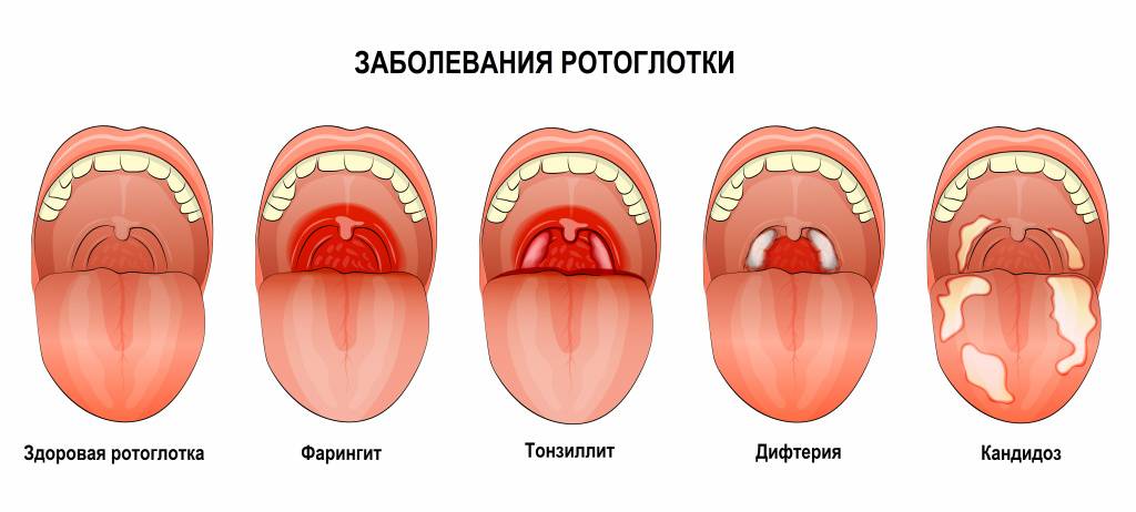 Тонзиллит: симптомы, лечение у детей, взрослых, беременных