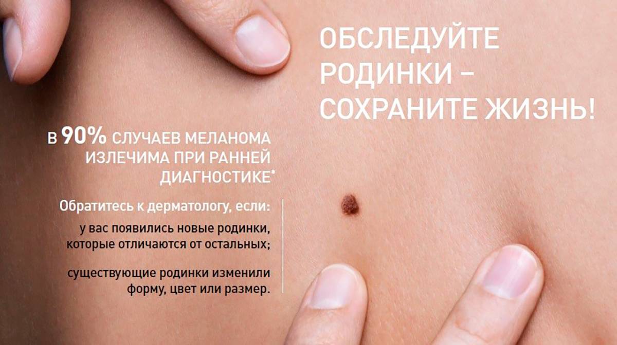 В чем основные отличия родинки от папилломы