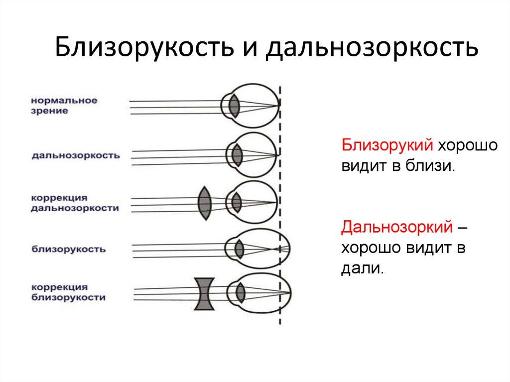 Близорукость и дальнозоркость: что это такое, в чем разница, отличие, чем отличается плюсовое зрение, различия, как определить, как понять